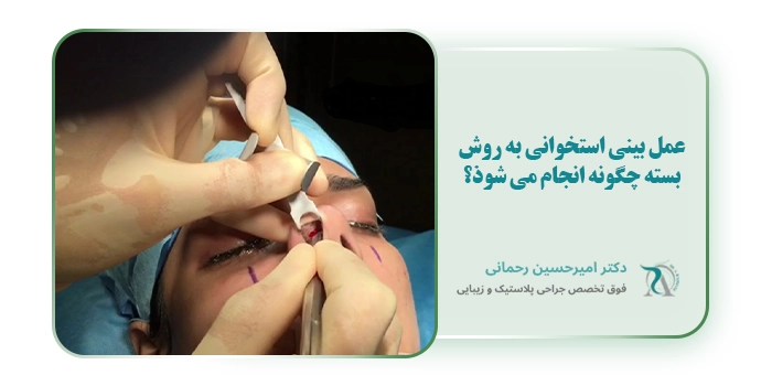 عمل بینی استخوانی به روش بسته چگونه انجام می شوذ؟
