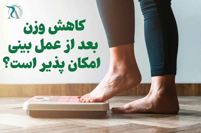 کم کردن وزن بعد رینوپلاستی