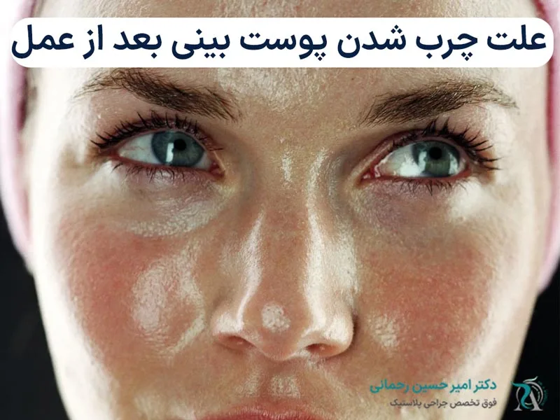 دلایل چرب شدن پوست بعد عمل بینی
