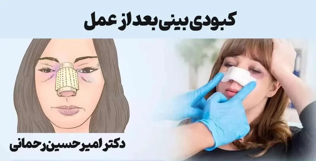 علل کبودی بینی بعد عمل