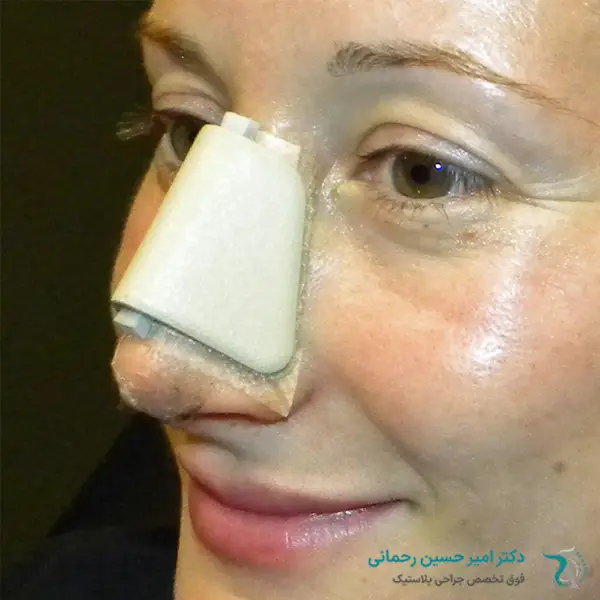 دلایل استفاده از اسپلینت بینی
