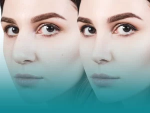 برگشت بینی گوشتی بعد از عمل