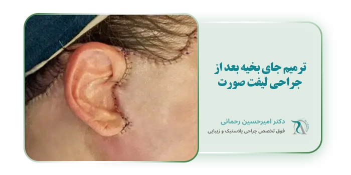 ترمیم جای بخیه بعد از جراحی لیفت صورت