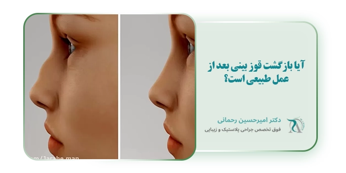آیا بازگشت قوز بینی بعد از عمل طبیعی است؟