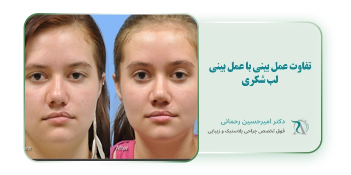 تفاوت عمل بینی با عمل بینی لب شکری