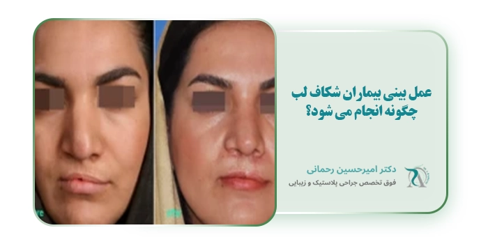 عمل بینی بیماران شکاف لب چگونه انجام می شود؟